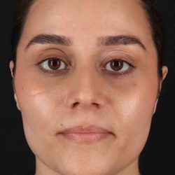 Rhinoplasty Before & After Patient #2873