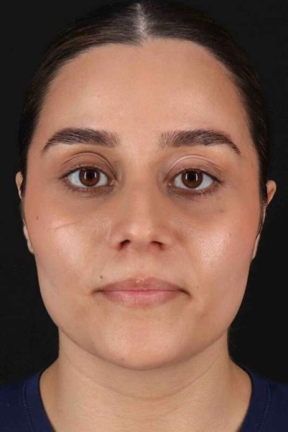 Rhinoplasty Before & After Patient #2873