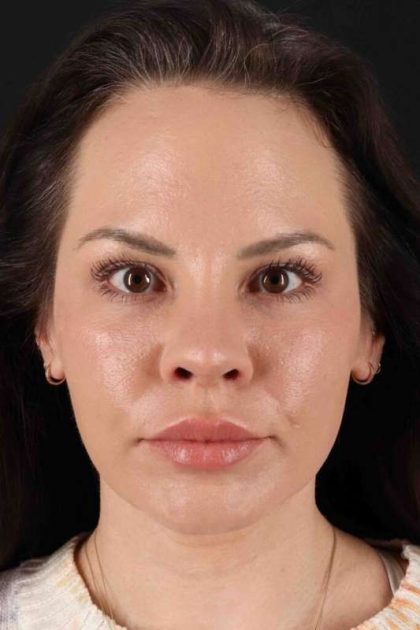 Rhinoplasty Before & After Patient #2884