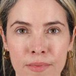 Browlift Before & After Patient #1231