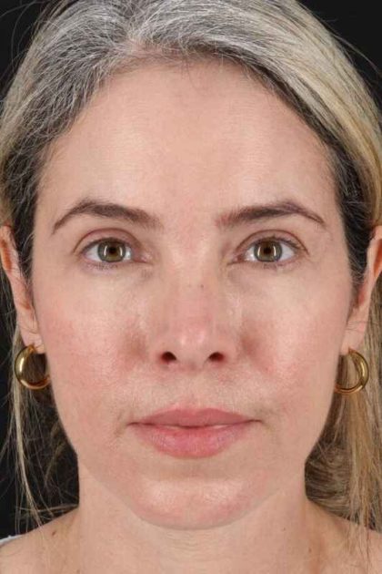 Browlift Before & After Patient #1231