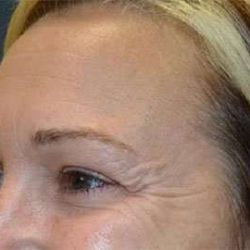 Browlift Before & After Patient #1405