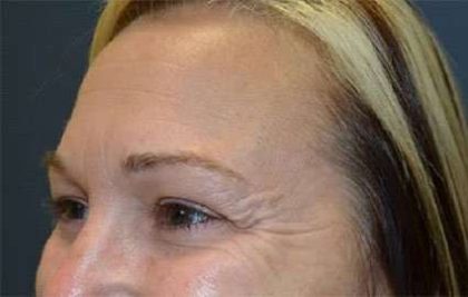 Browlift Before & After Patient #1405