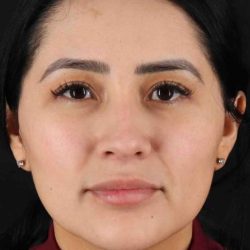 Rhinoplasty Before & After Patient #2895