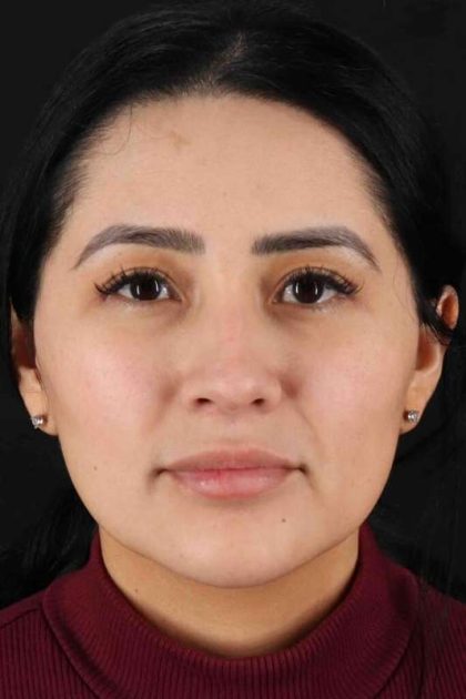 Rhinoplasty Before & After Patient #2895
