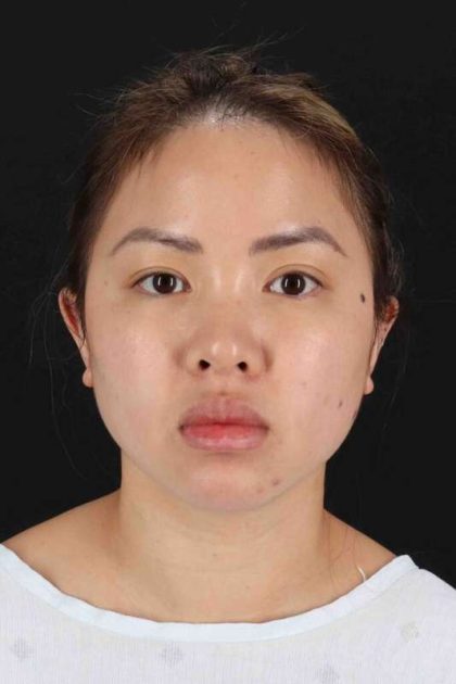 Rhinoplasty Before & After Patient #2906