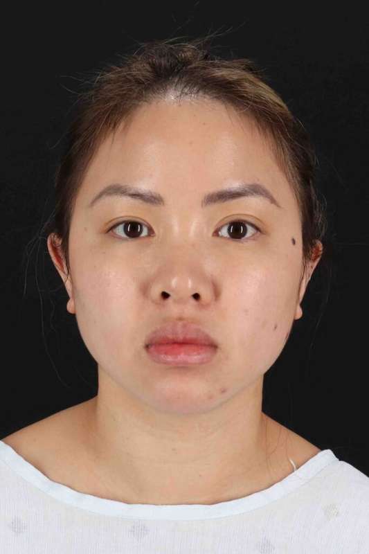 Rhinoplasty Before & After Patient #2906