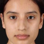 Rhinoplasty Before & After Patient #2917