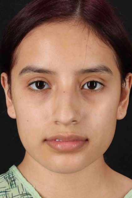 Rhinoplasty Before & After Patient #2917