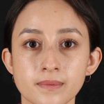 Rhinoplasty Before & After Patient #2928