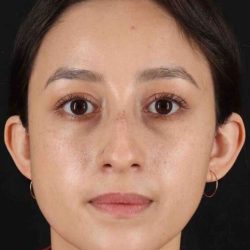 Rhinoplasty Before & After Patient #2928
