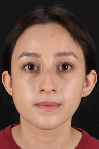 Rhinoplasty Before & After Patient #2928
