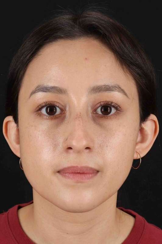 Rhinoplasty Before & After Patient #2928