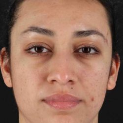 Rhinoplasty Before & After Patient #2939