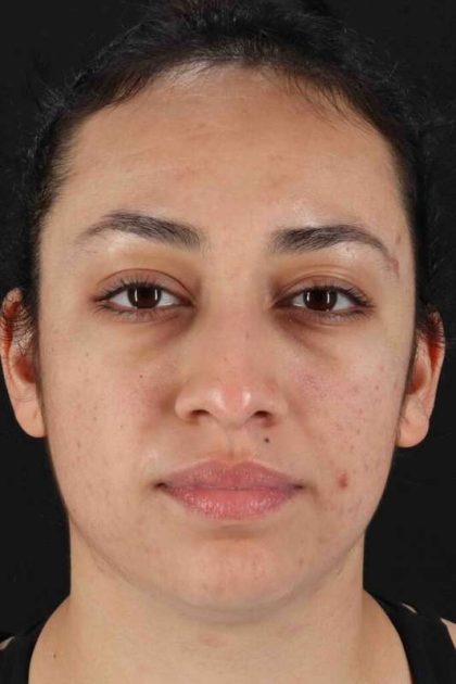 Rhinoplasty Before & After Patient #2939