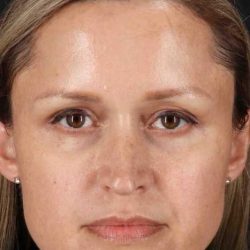 Rhinoplasty Before & After Patient #2950