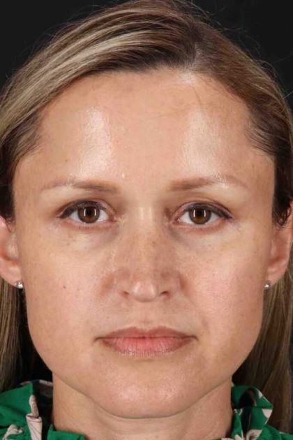 Rhinoplasty Before & After Patient #2950