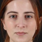 Rhinoplasty Before & After Patient #2961