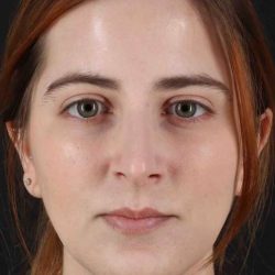 Rhinoplasty Before & After Patient #2961