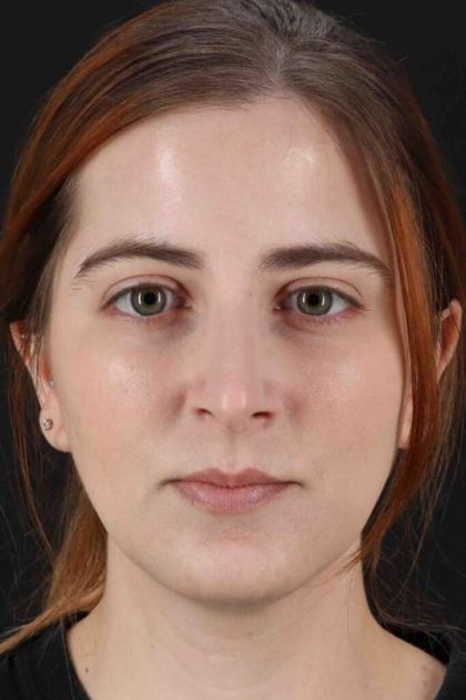 Rhinoplasty Before & After Patient #2961