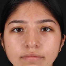 Rhinoplasty Before & After Patient #2972