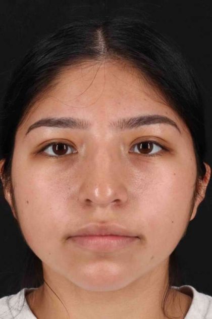 Rhinoplasty Before & After Patient #2972