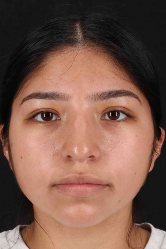 Rhinoplasty Before & After Patient #2972