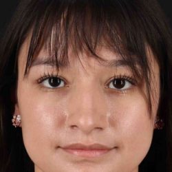 Rhinoplasty Before & After Patient #2983