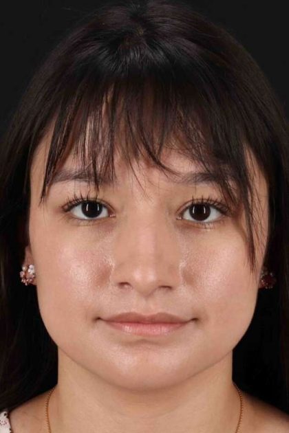 Rhinoplasty Before & After Patient #2983