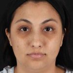 Rhinoplasty Before & After Patient #2994