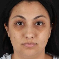Rhinoplasty Before & After Patient #2994