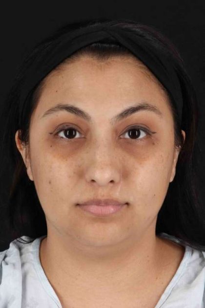 Rhinoplasty Before & After Patient #2994