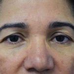 Browlift Before & After Patient #1408