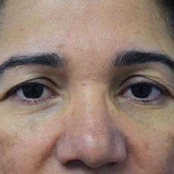 Browlift Before & After Patient #1408