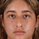 Rhinoplasty Before & After Patient #3016