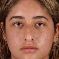 Rhinoplasty Before & After Patient #3016