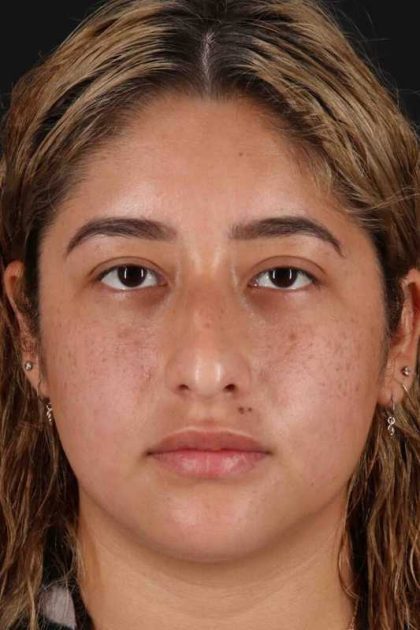 Rhinoplasty Before & After Patient #3016