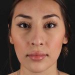 Rhinoplasty Before & After Patient #3027
