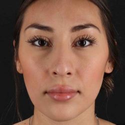 Rhinoplasty Before & After Patient #3027