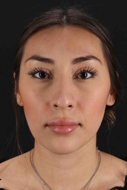 Rhinoplasty Before & After Patient #3027