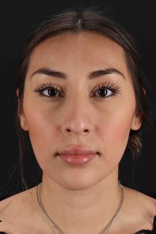Rhinoplasty Before & After Patient #3027