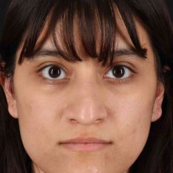 Rhinoplasty Before & After Patient #3038