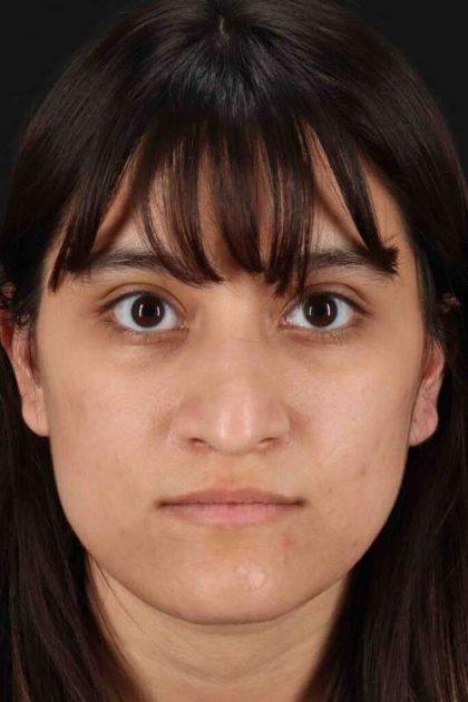 Rhinoplasty Before & After Patient #3038