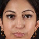 Rhinoplasty Before & After Patient #3049