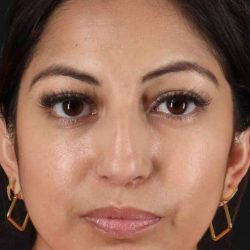 Rhinoplasty Before & After Patient #3049