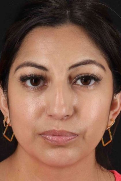 Rhinoplasty Before & After Patient #3049