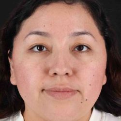 Rhinoplasty Before & After Patient #3060