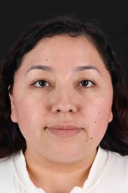 Rhinoplasty Before & After Patient #3060