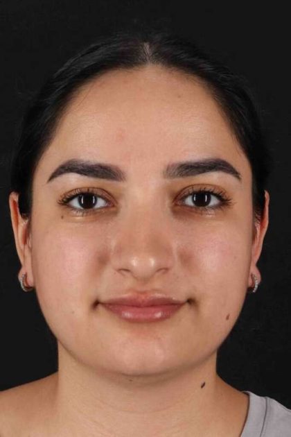 Rhinoplasty Before & After Patient #3071