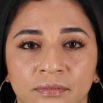 Rhinoplasty Before & After Patient #3082